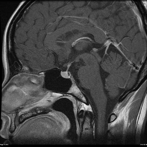 small rathke's cleft cyst.